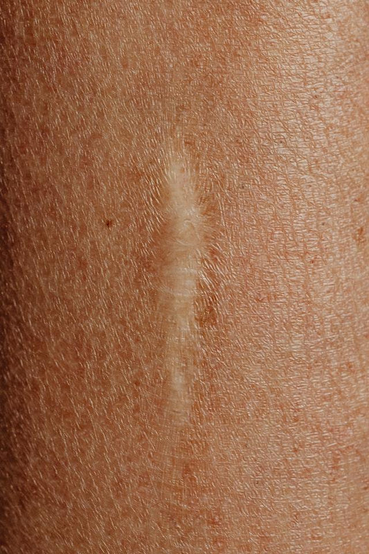 Ozonated Oils for Scar Prevention: Natural Remedies that Promote Healing - Naturally Wyld
