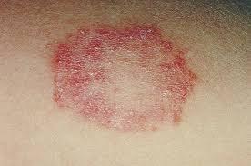 Unlock the Secrets of Ozonated Oils for Ringworm Relief Now